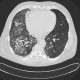 Alveolar hemorrhage, ANCA vasculitis, paraseptal emphysema: CT - Computed tomography
